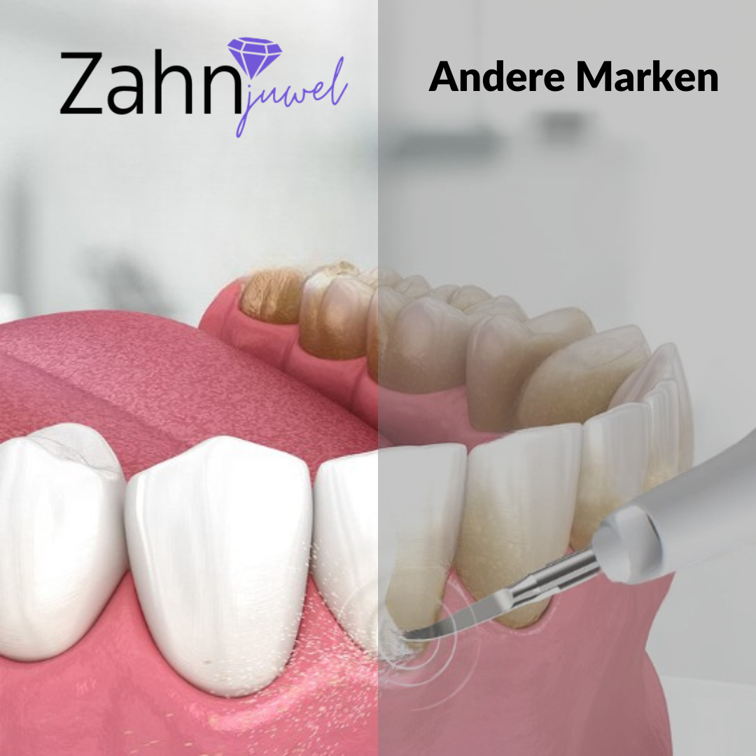 ZahnJuwel™ Zahnstein Bundle